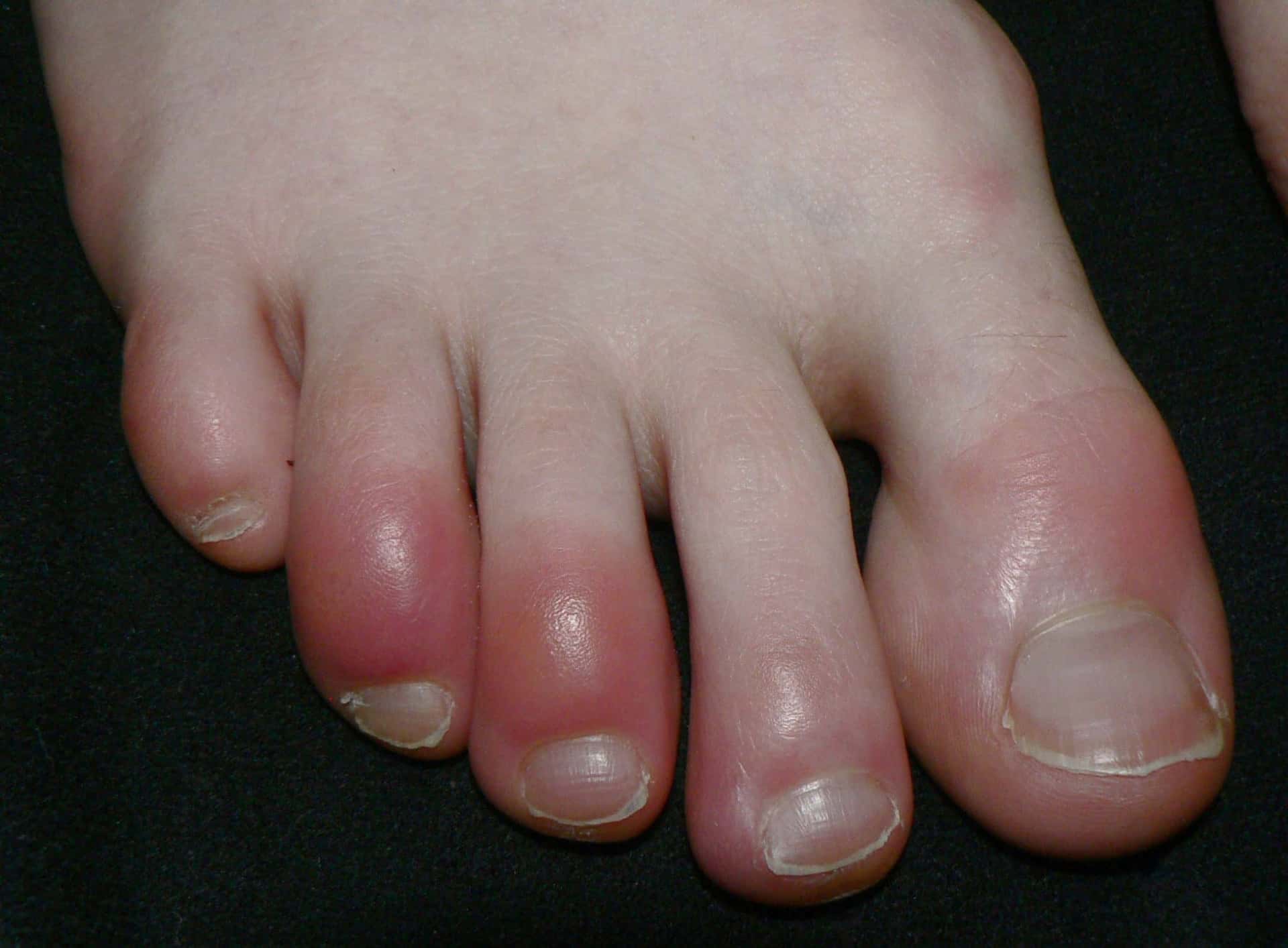 What Are Chilblains? Causes, Symptoms & Prevention Tips for Trekkers What Are Chilblains? Causes, Symptoms & Prevention Tips for Trekkers
