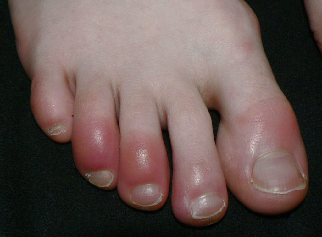 Chilblains: Prevention Tips and Measures